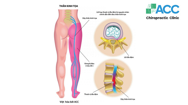 Hậu quả của tư thế an tọa sai: Thoát vị đĩa đệm và chèn ép dây thần kinh cột sống
