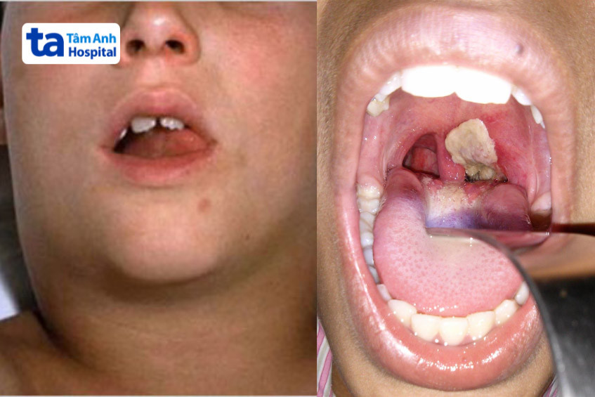 Hình ảnh người bệnh nhiễm bạch hầu họng