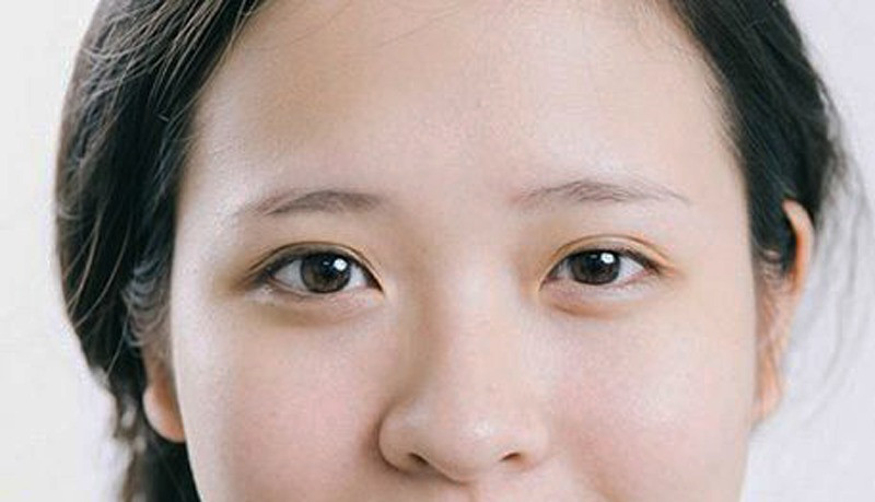Một ví dụ về mắt âm dương với những dấu hiệu không tốt