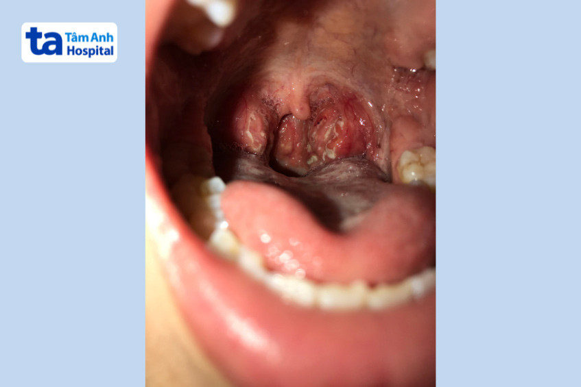 Vi khuẩn bạch hầu gây tổn thương vùng hầu họng người bệnh